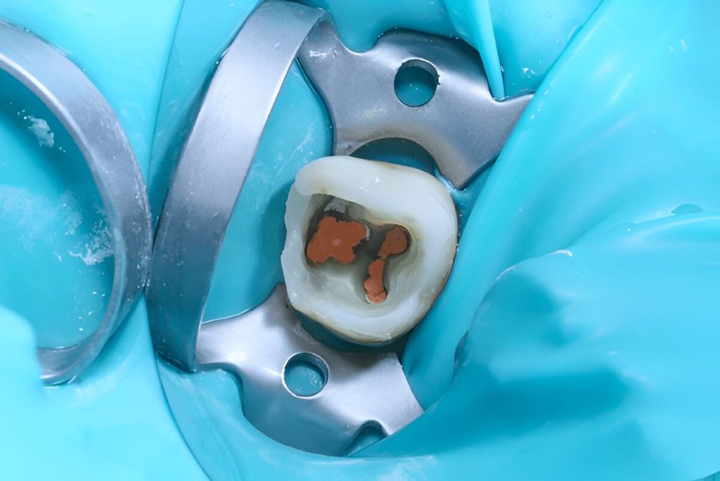 root canal therapy in london, on