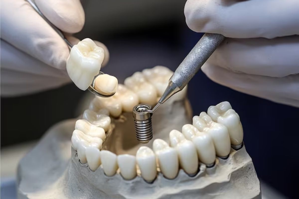 dental implant crown placement for permanent tooth replacement and smile restoration
