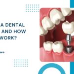 what is a dental implant and how does it work?