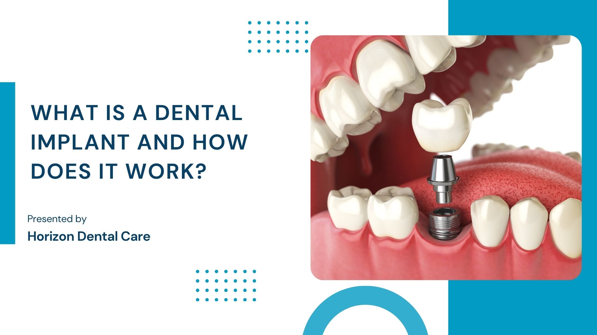 what is a dental implant and how does it work?