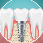 Looking for dental implants in London? This blog explains why choosing dental implants near you is the best way to replace missing teeth naturally and securely. Explore costs, benefits, and recovery tips.
