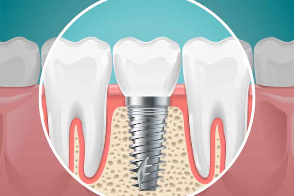Looking for dental implants in London? This blog explains why choosing dental implants near you is the best way to replace missing teeth naturally and securely. Explore costs, benefits, and recovery tips.