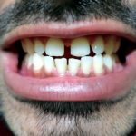 Fix Crooked or Gapped Teeth
