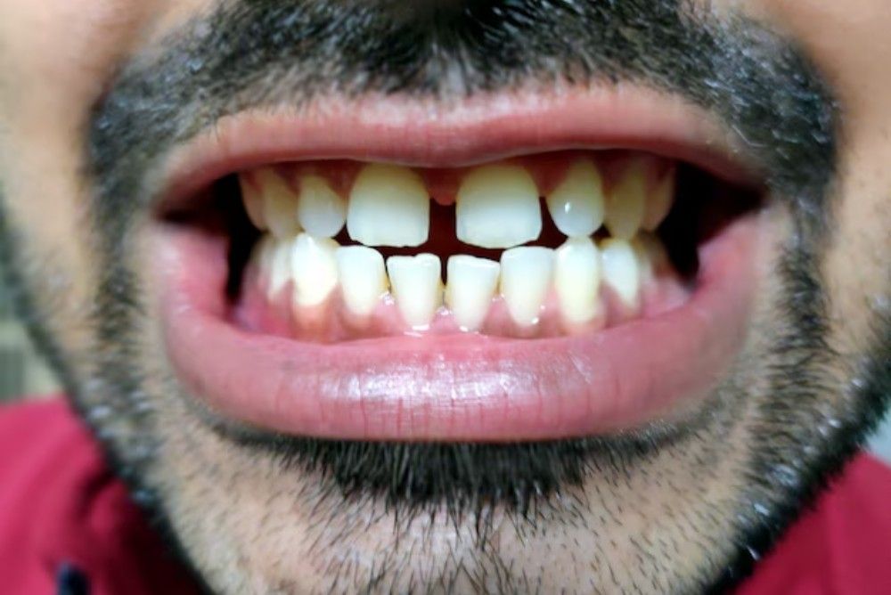 Can Cosmetic Treatments Fix Crooked or Gapped Teeth?