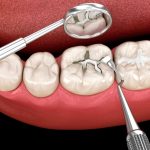 dental filling procedure to restore a cavity and protect tooth structure