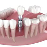 dental implant with crown for permanent tooth replacement and smile restoration