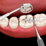 how do i know if you actually need a dental filling