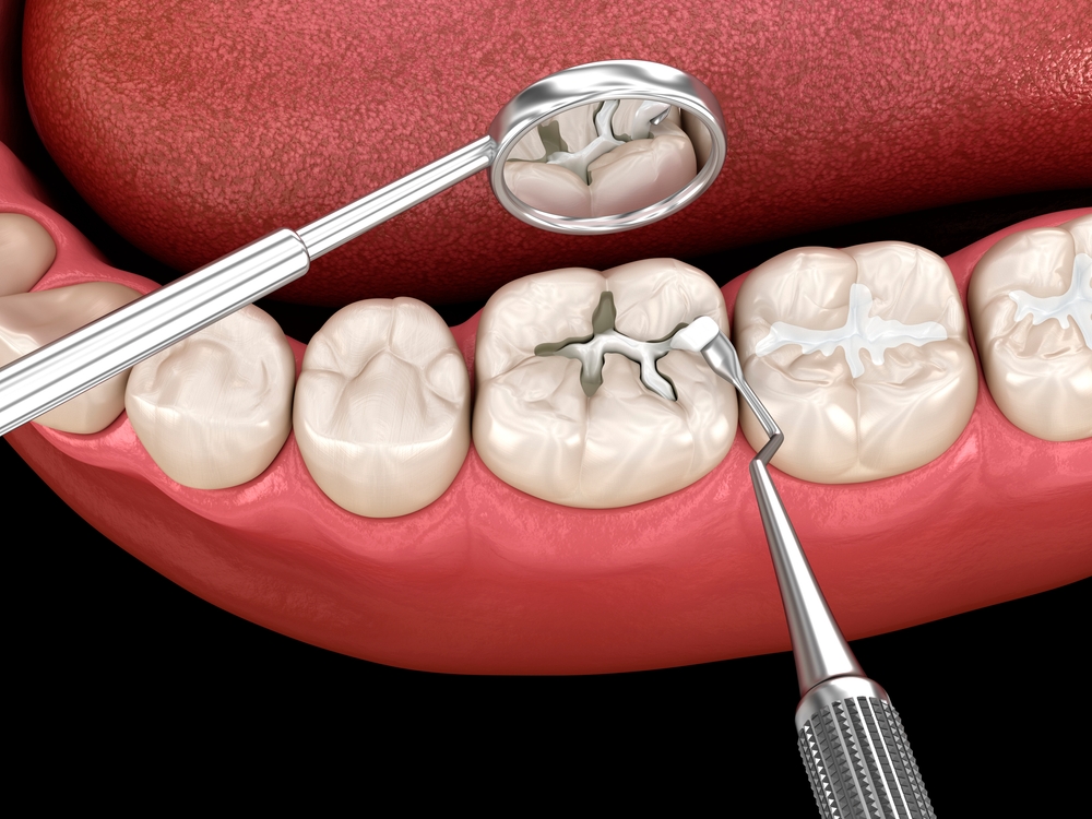 how do i know if you actually need a dental filling
