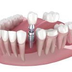 dental implant procedure showing implant