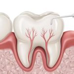 tooth roots showing root canal infection and internal tooth structure