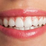 bright smile after professional teeth whitening