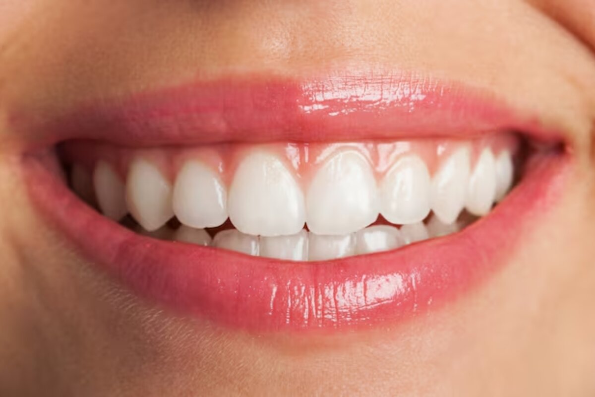 bright smile after professional teeth whitening