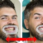 Dental implants before and after realistic results